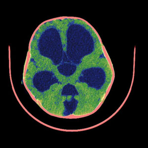 MRI scan of a brain cross-section in false-color: blue regions indicate ventricles, green areas show brain tissue, and a red outline highlights the skull.