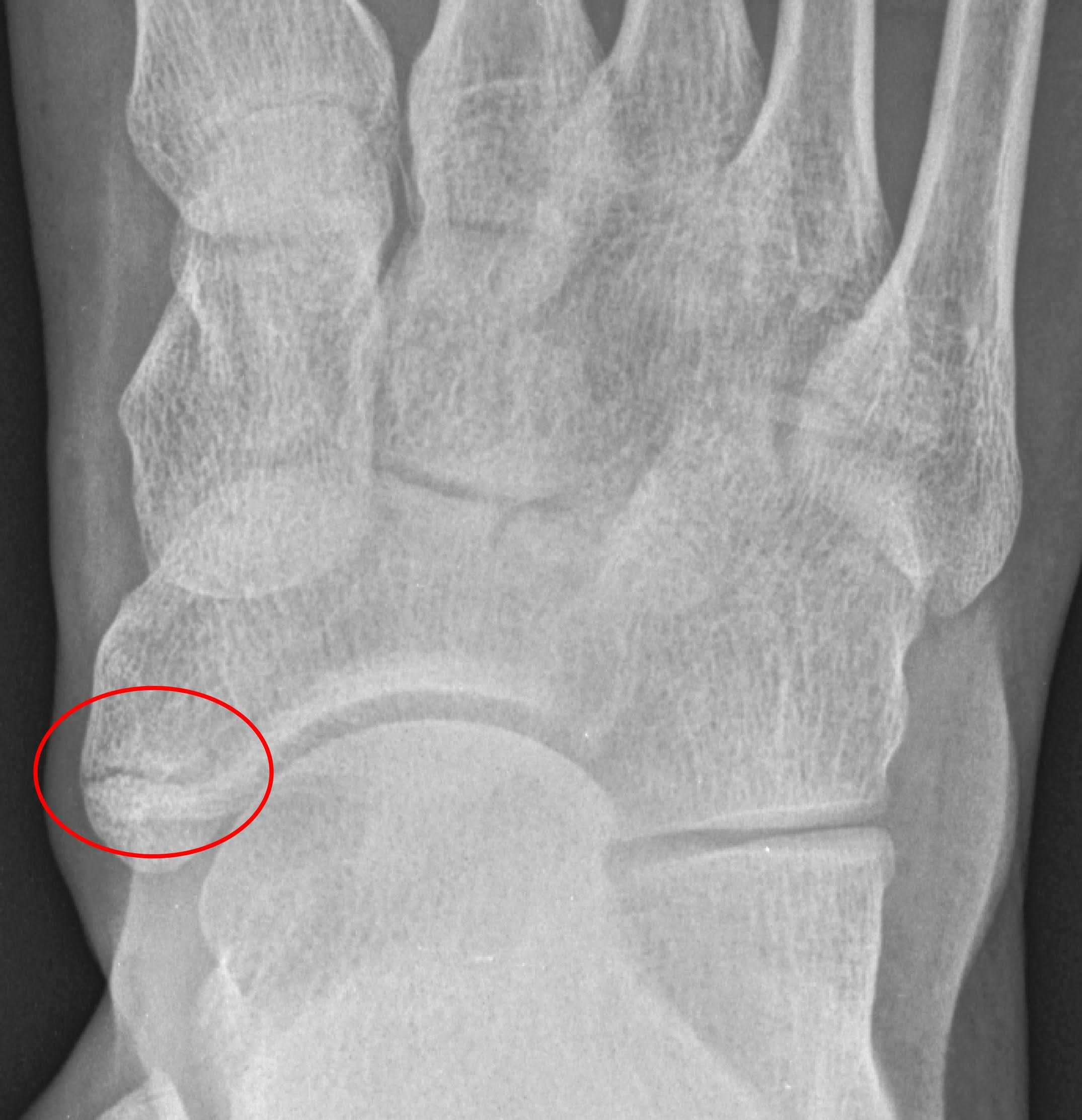 X-Ray of a foot showing a hairline fracture