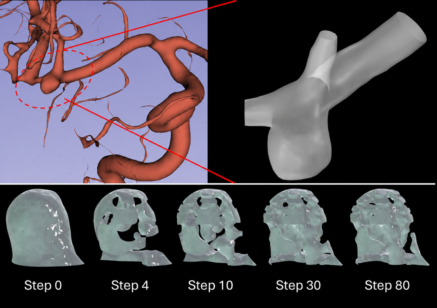 “Patient-specific cerebral aneurysm model and the progressive development of a porous implant through topology-optimization iterations.”
