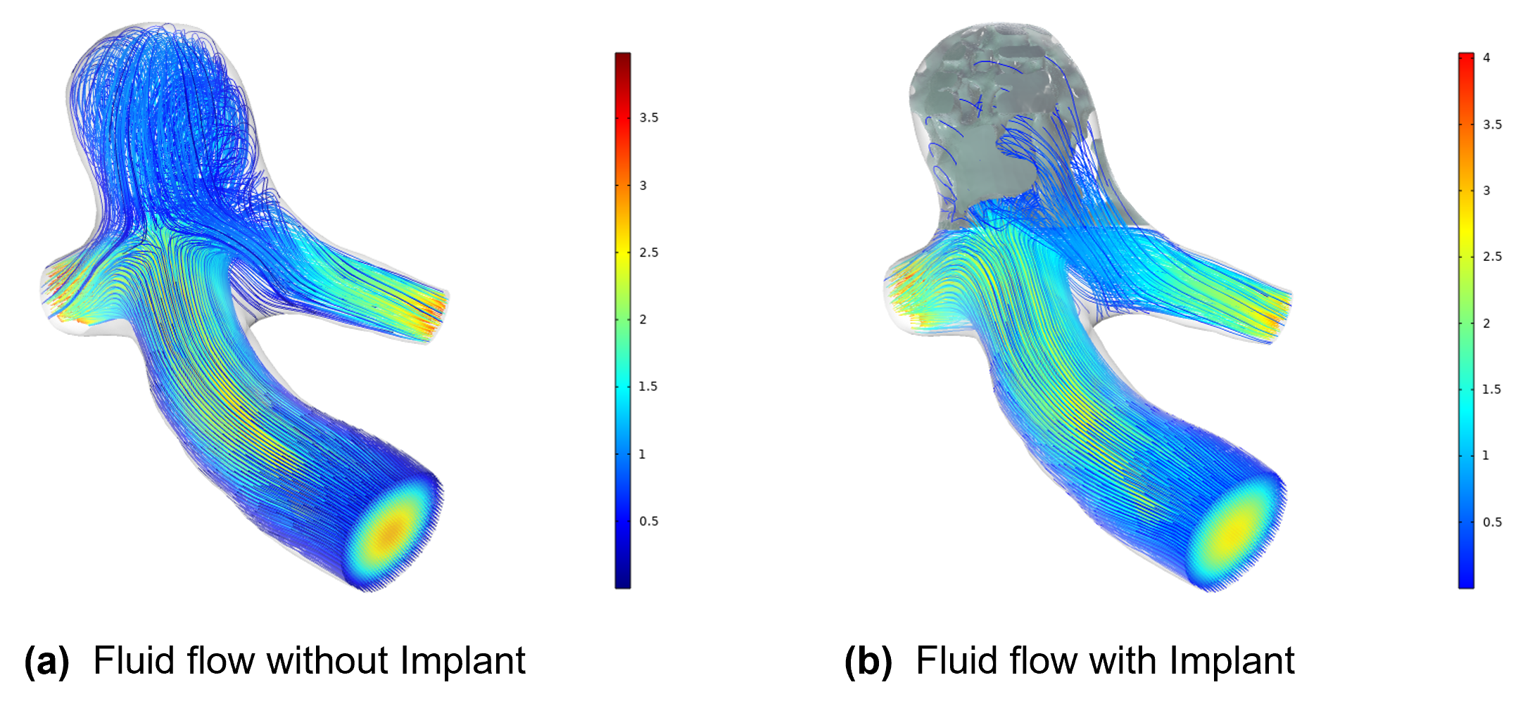 “Computer simulation comparing blood flow through a cerebral aneurysm before and after placement of a patient-specific implant, showing reduced flow within the aneurysm after treatment.”
