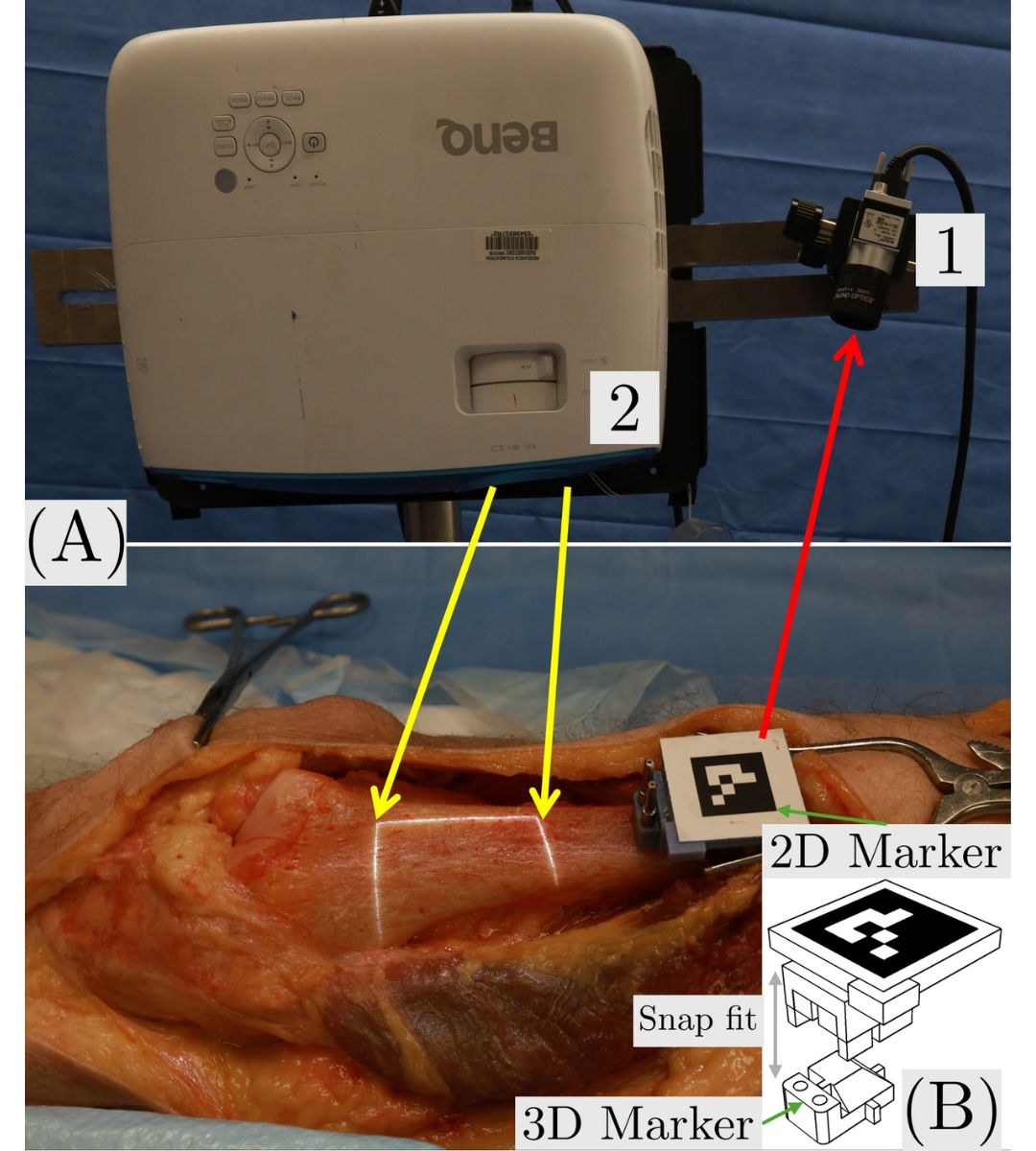 The vision-guided surgical system: In (A), Label 1 indicates a HD camera, and Label 2 indicates a projector. The pre-operative U-shaped osteotomy lines are projected onto the bone surface for guiding the resection of osteosarcoma. In (B): ”A zoom-in view of the 2D marker next to the osteotomy lines for real-time tracking, which is snapped onto a 3D marker on the bone surface.